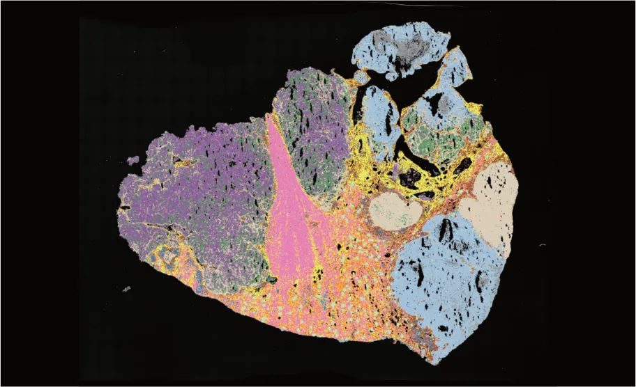 stereo-seq-transcriptomics-FF-LCD-human-carcinoma